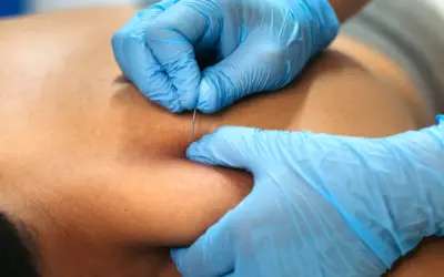 How Dry Needling Helps Relieve Muscle Tension and Speed Recovery