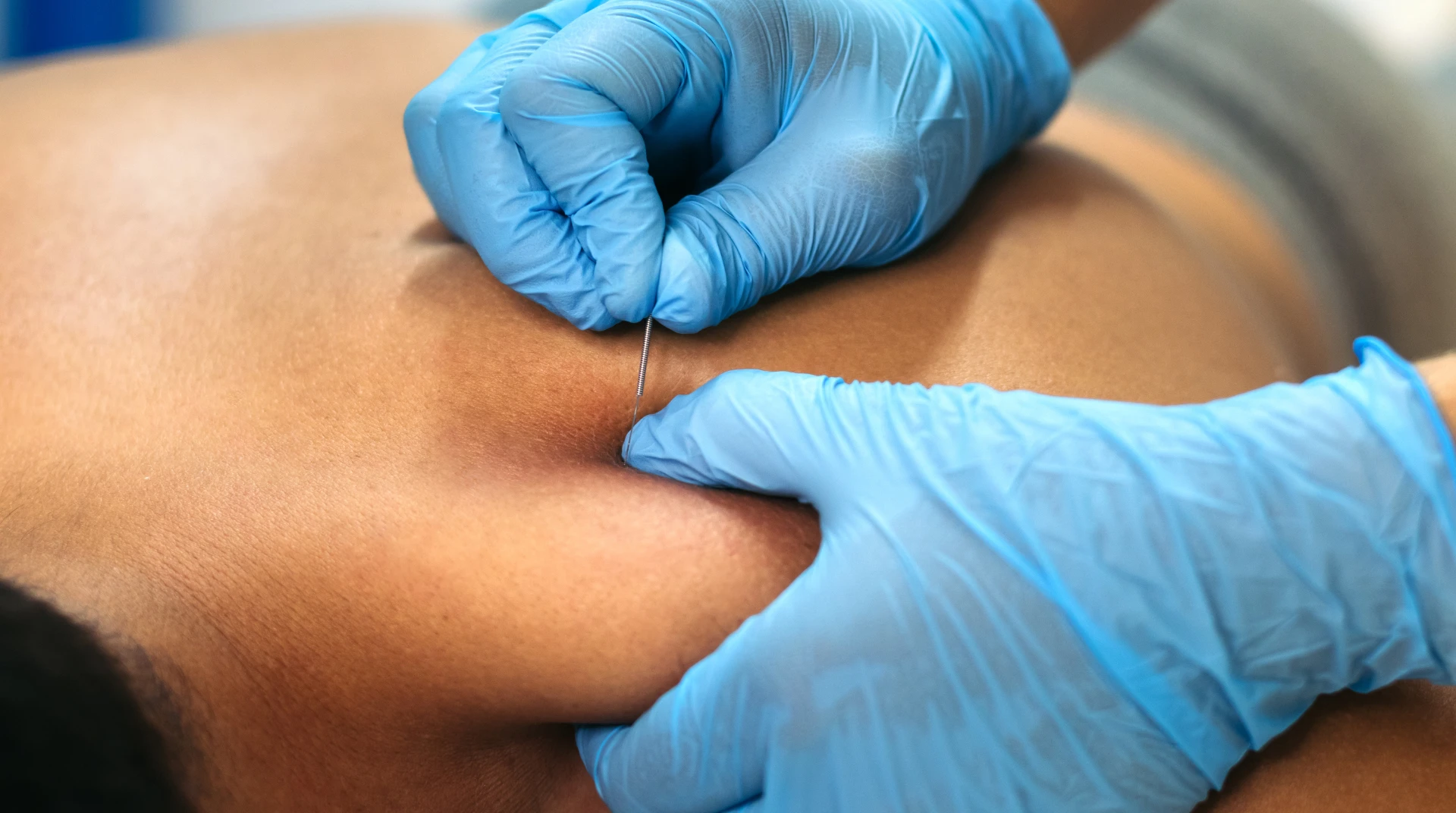 Dry-Needling-3 (1)